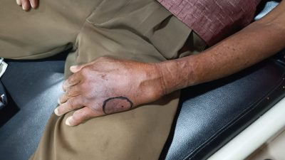 Digigit Kobra Saat Membabat Rumput, Warga Karang Intan Meregang Nyawa